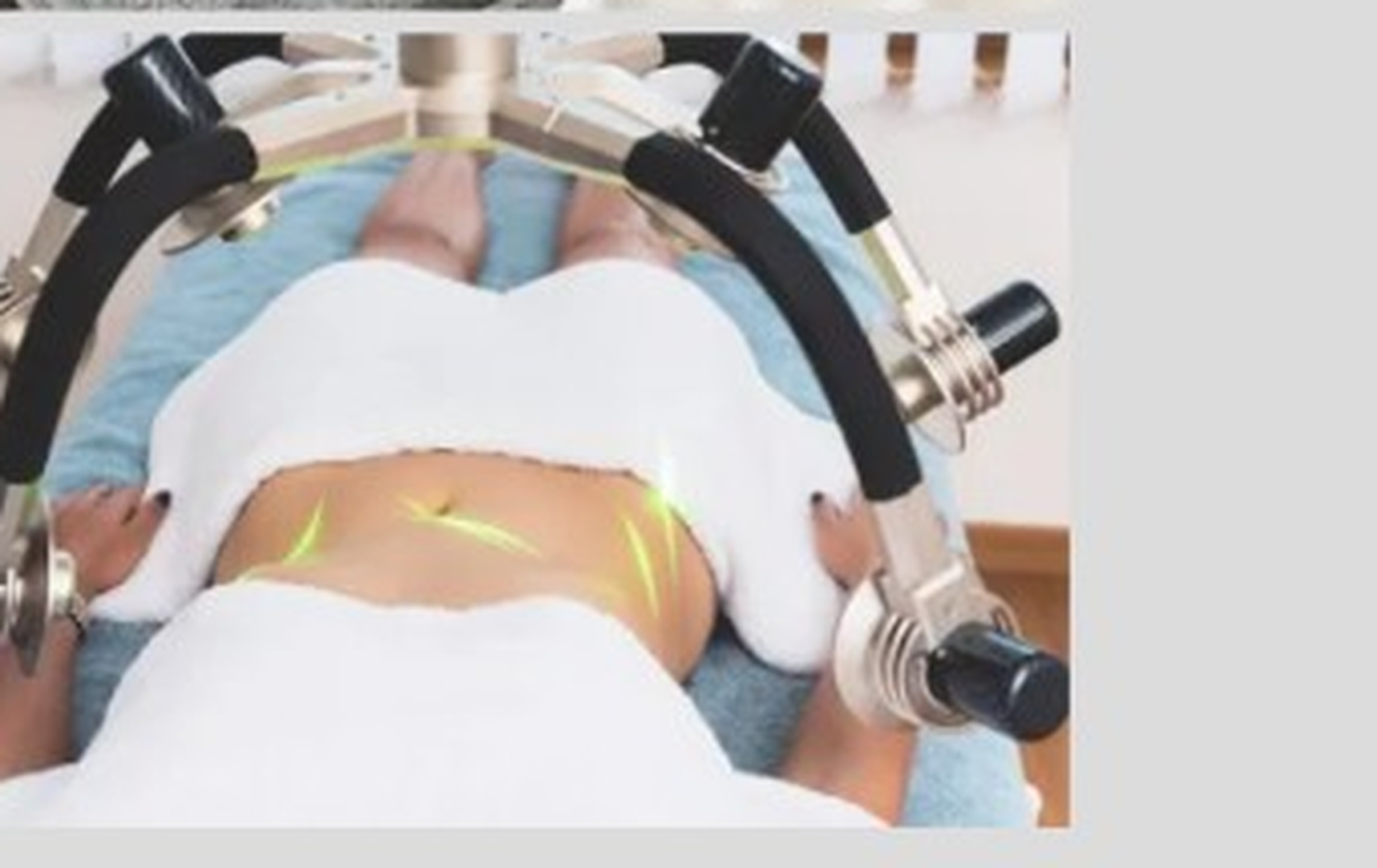 Lipolaser treatment